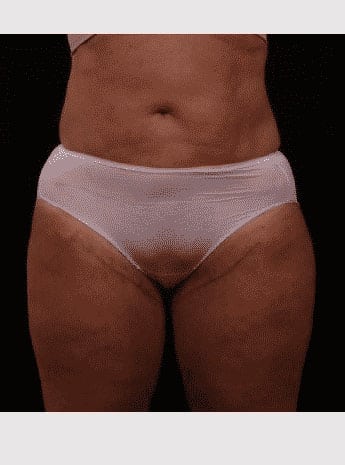 After Image: Inner Thigh Lift - front
