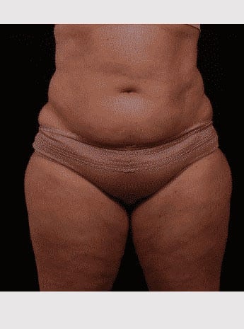 Before Image: Inner Thigh Lift - front