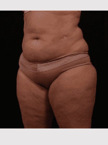 Before Image: Inner Thigh Lift - left-front-oblique