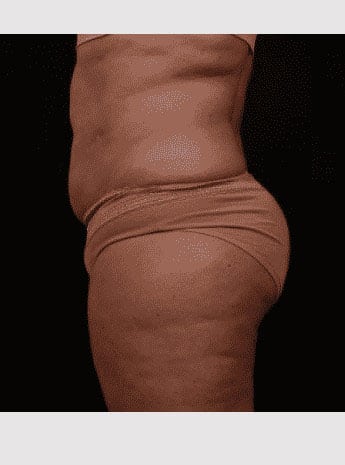 Before Image: Inner Thigh Lift - left-side