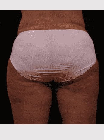 After Image: Inner Thigh Lift - back