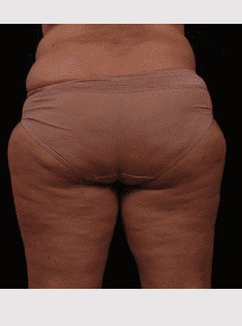 Before Image: Inner Thigh Lift - back