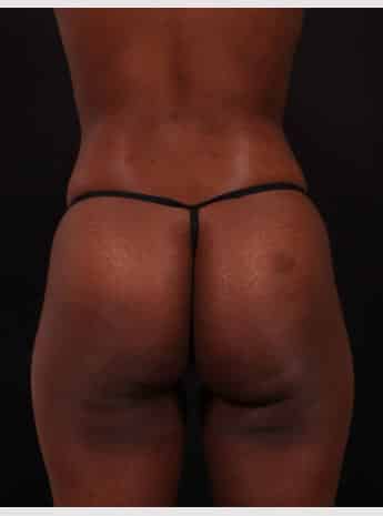 After Image: Brazilian Butt Augmentation (Butt Lift) - back