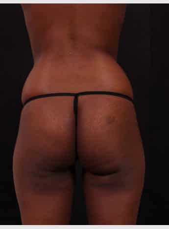 Before Image: Brazilian Butt Augmentation (Butt Lift) - back