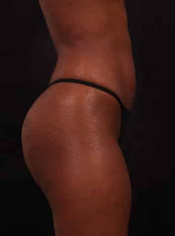 After Image: Brazilian Butt Augmentation (Butt Lift) - right-side