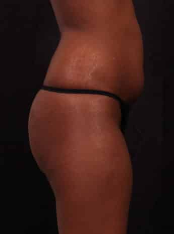 Before Image: Brazilian Butt Augmentation (Butt Lift) - right-side