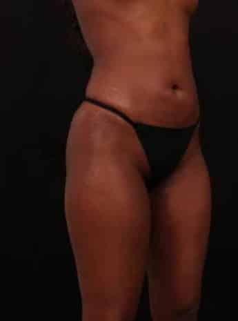 After Image: Liposuction - right-front-oblique