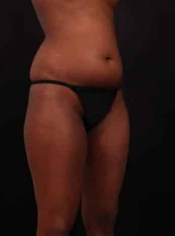 Before Image: Liposuction - right-front-oblique