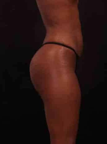 After Image: Liposuction - right-side