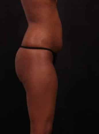 Before Image: Liposuction - right-side