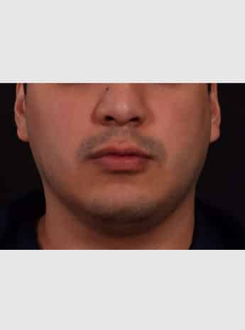 Chin Implant, Buccal Fat Removal & Fat Grafting to Face