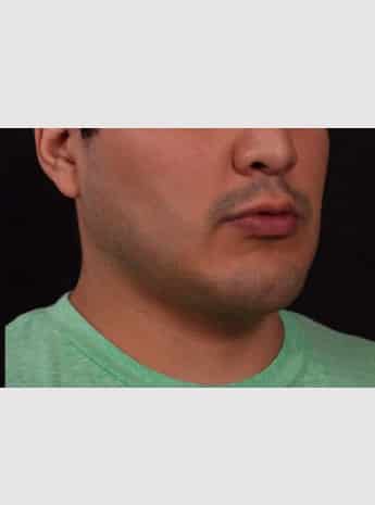 After Image: Chin Implant, Buccal Fat Removal & Fat Grafting to Face - right-front-oblique