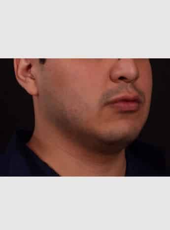 Before Image: Chin Implant, Buccal Fat Removal & Fat Grafting to Face - right-front-oblique