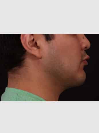 After Image: Chin Implant, Buccal Fat Removal & Fat Grafting to Face - right-side