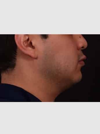 Before Image: Chin Implant, Buccal Fat Removal & Fat Grafting to Face - right-side