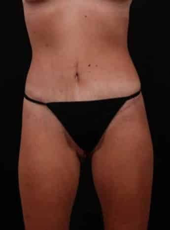 After Image: Tummy Tuck (Abdominoplasty) - front