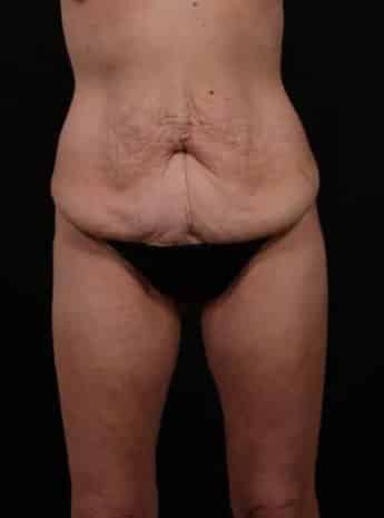 Before Image: Tummy Tuck (Abdominoplasty) - front