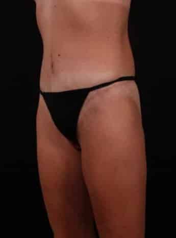 After Image: Tummy Tuck (Abdominoplasty) - left-front-oblique