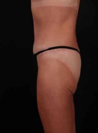 After Image: Tummy Tuck (Abdominoplasty) - left-side