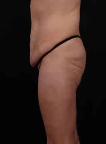 Before Image: Tummy Tuck (Abdominoplasty) - left-side