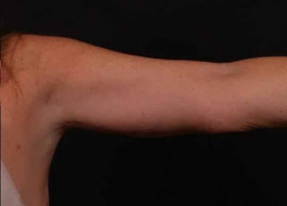 After Image: Brachioplasty (Arm Lift) - front