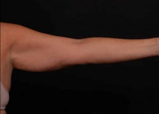 Before Image: Brachioplasty (Arm Lift) - front