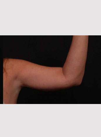 After Image: Brachioplasty (Arm Lift) - front