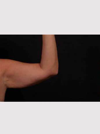 Before Image: Brachioplasty (Arm Lift) - front