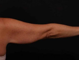 Before Image: Brachioplasty (Arm Lift) - back