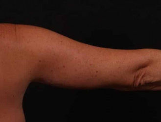 After Image: Brachioplasty (Arm Lift) - back