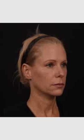 Before Image: Facial Fillers - right-front-oblique