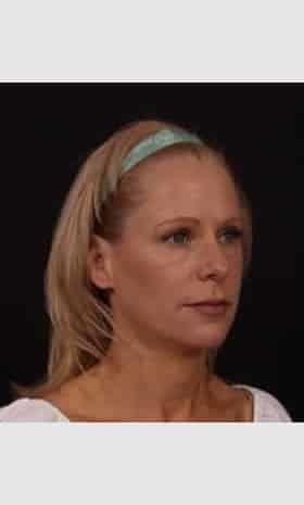 After Image: Facial Fillers - right-front-oblique