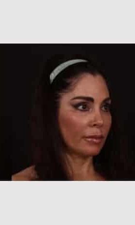 Before Image: Facial Fillers - right-front-oblique