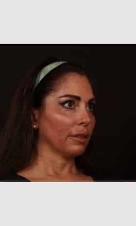 After Image: Facial Fillers - right-front-oblique