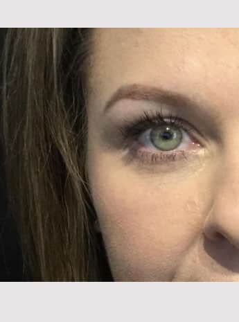 After Image: Facial Fillers - front