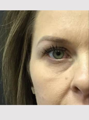 Before Image: Facial Fillers - front