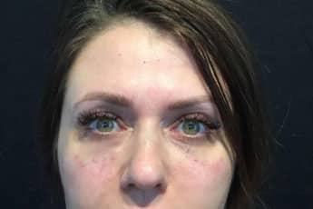 After Image: Facial Fillers - front