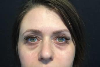 Before Image: Facial Fillers - front