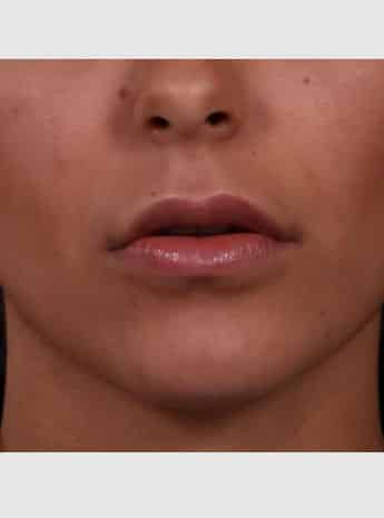 After Image: Lip Augmentation - front