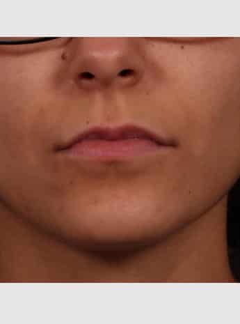 Before Image: Lip Augmentation - front