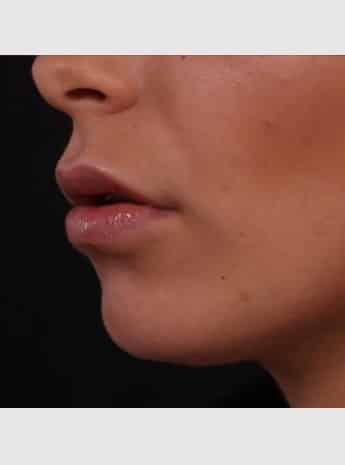 After Image: Lip Augmentation - left-front-oblique
