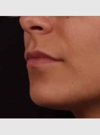 Before Image: Lip Augmentation - left-front-oblique