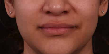 After Image: Lip Augmentation - front