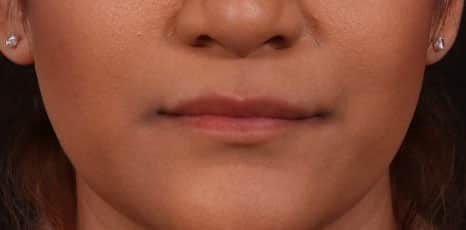 Before Image: Lip Augmentation - front