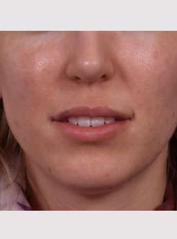 After Image: Lip Augmentation - front