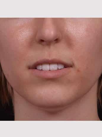 Before Image: Lip Augmentation - front