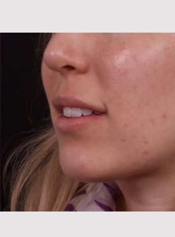 After Image: Lip Augmentation - left-front-oblique