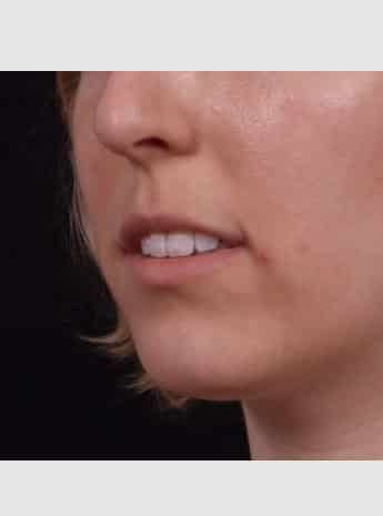 Before Image: Lip Augmentation - left-front-oblique