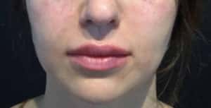 After Image: Lip Augmentation
