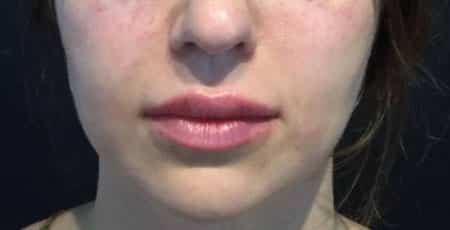 After Image: Lip Augmentation - front